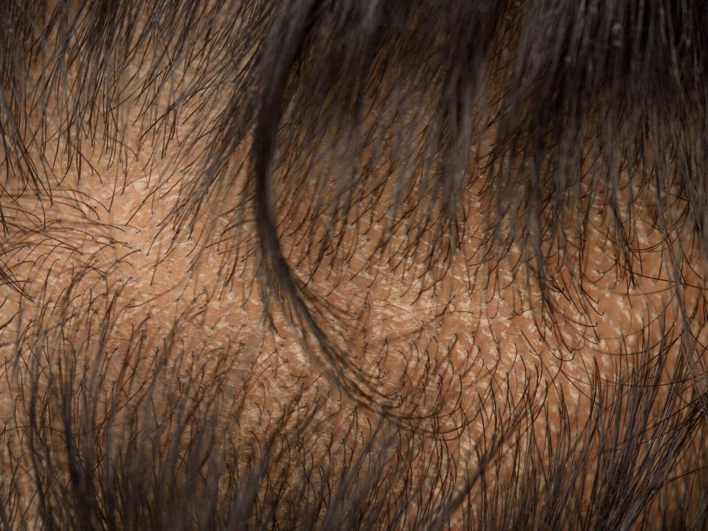 Een vorm van haaruitval is telogeen effluvium